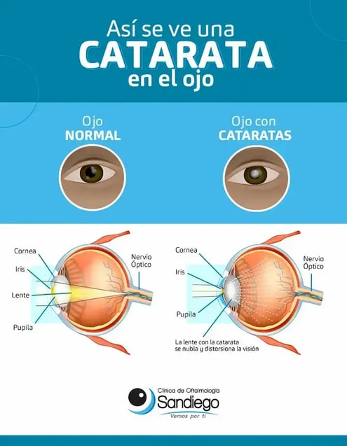 catarata-en-ojo